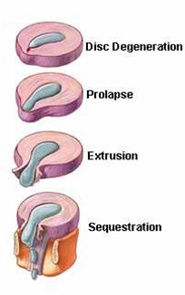 Herniation